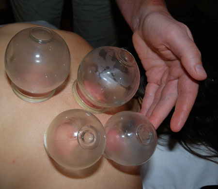 Cupping-2